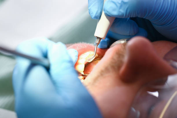 Best Knocked-Out Tooth (Avulsed Tooth) Treatment in Southchase, FL
